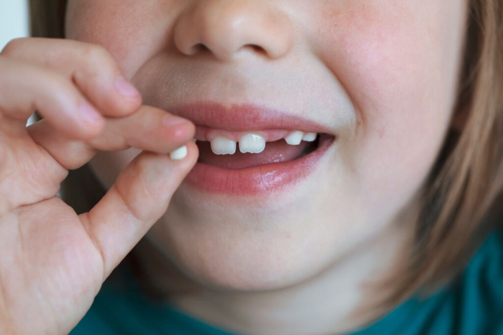 The time remaining until natural exfoliation also influences the decision between a filling and a tooth crown.