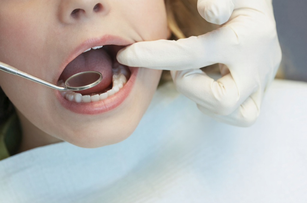 6-Year Molars Just Came In: Should You Seal Them Right Away?