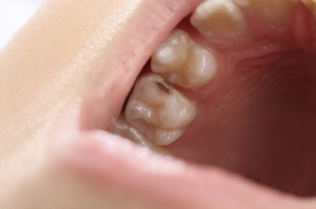 The first permanent molars are situated in a hard-to-clean location, making them among the most cavity-prone teeth in the mouth.