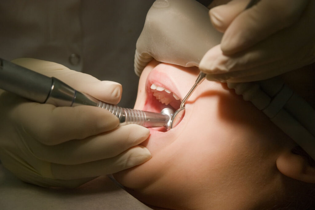 A child is under general anesthesia during her dental treatment.