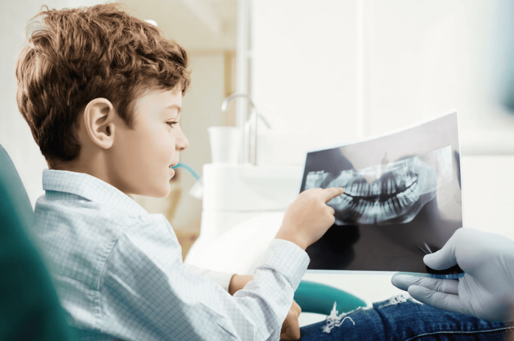 When the lesion is close to the pulp on X-ray, filling is preferred.