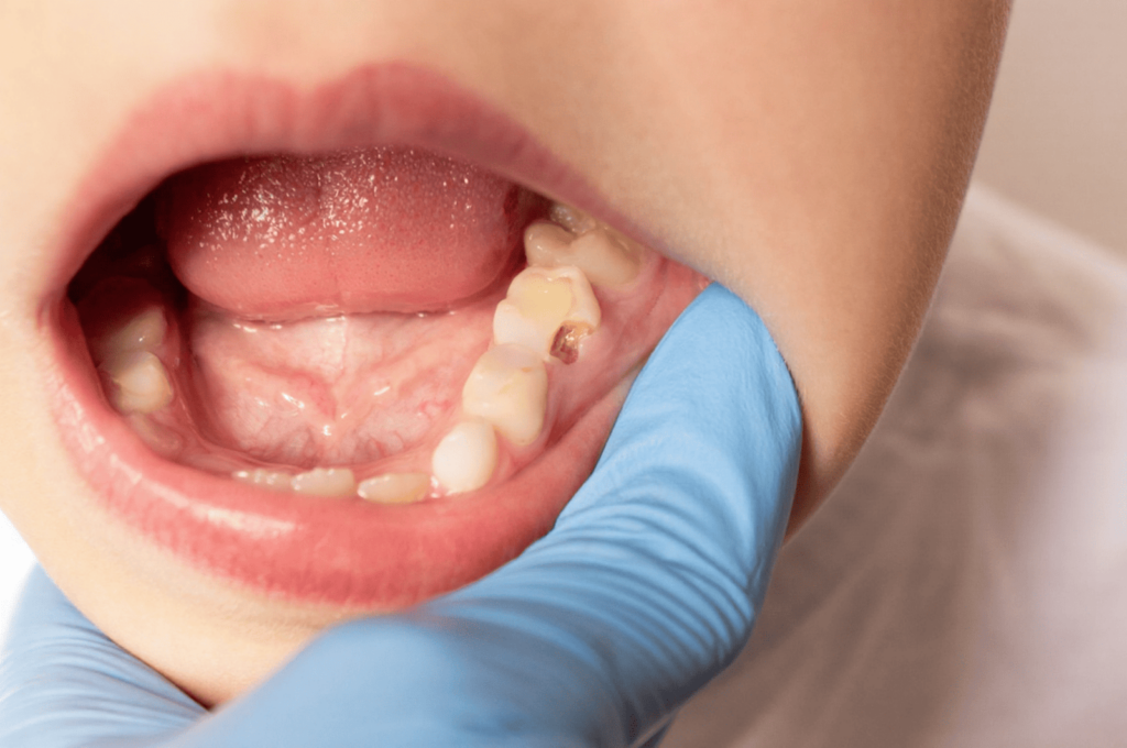 Parents often assume that fixing a small cavity in their child is straightforward.