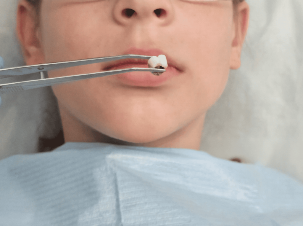 A boy is having a decayed tooth extracted instead of getting a filling or a crown.