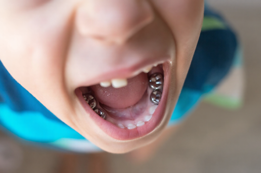 A boy girl has his cavities treated with tooth crowns.