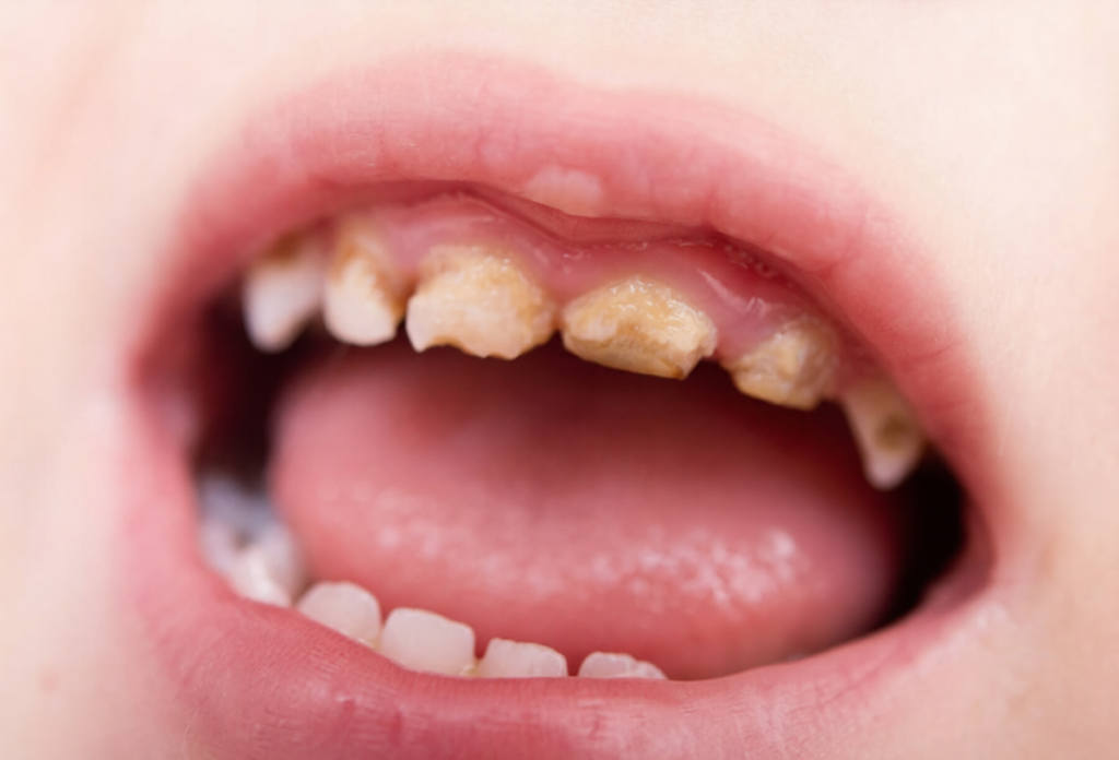 Decay in a primary tooth can spread to adjacent teeth.