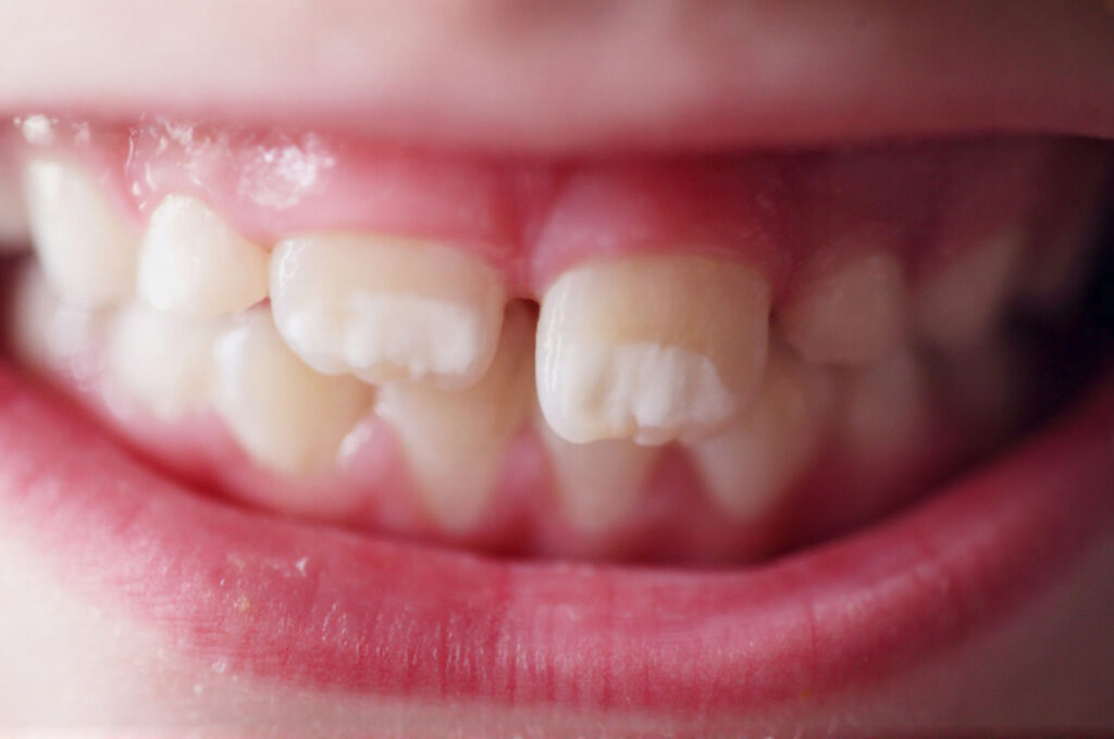 White Spots on Kids’ Teeth: The Clues That Separate Early Decay From Harmless Enamel Changes