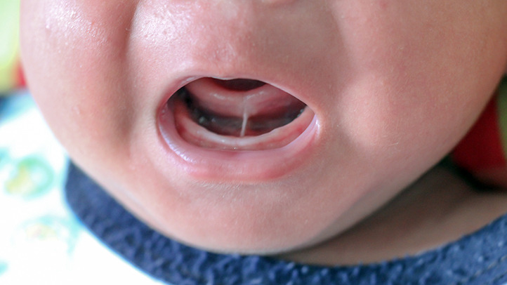 An infant was diagnosed with a tongue-tie.