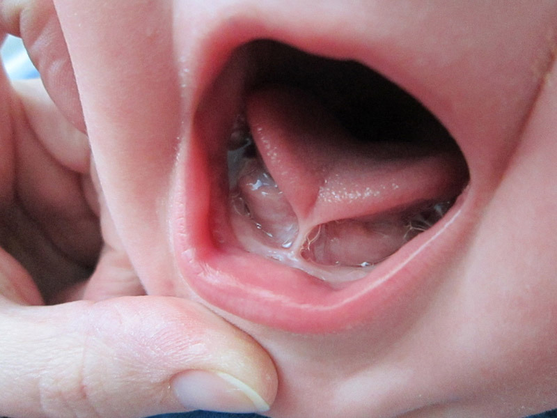 Tongue Tie or Lip Tie? What Has to Be True Before a Dental Release Is Worth Considering
