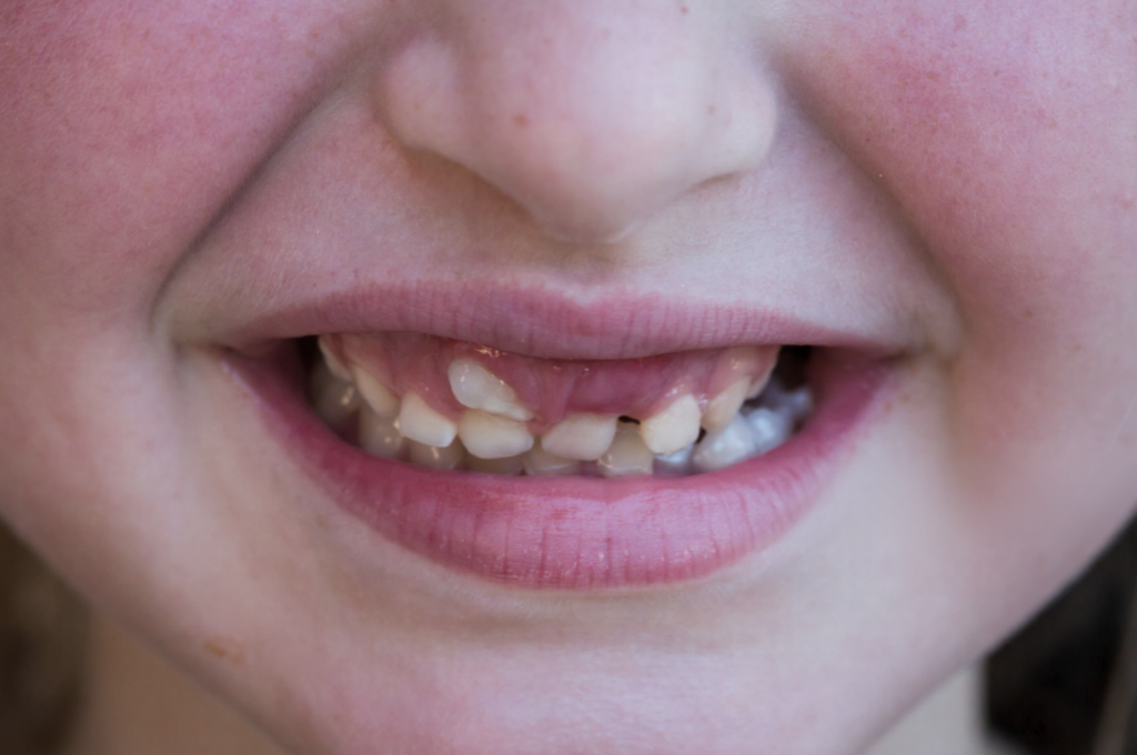 Two Rows of Teeth at Once? When “Shark Teeth” Need Help and When They Usually Don’t