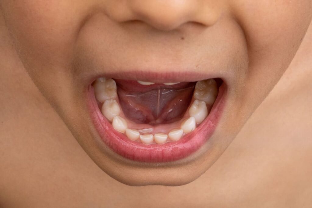A young boy has untreated shark teeth.