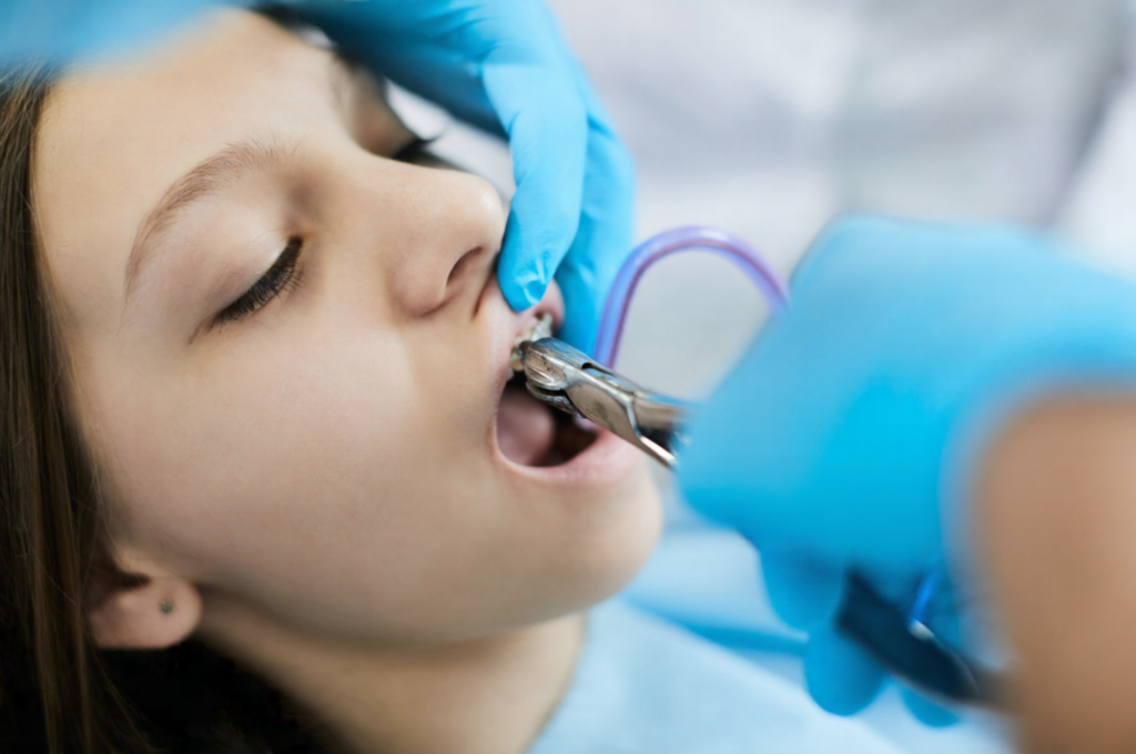 A dentist is extracting a young girl's shark tooth.