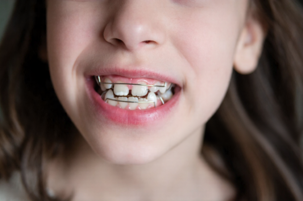 A young girl wears a space maintainer from an early age and feels comfortable and confident.