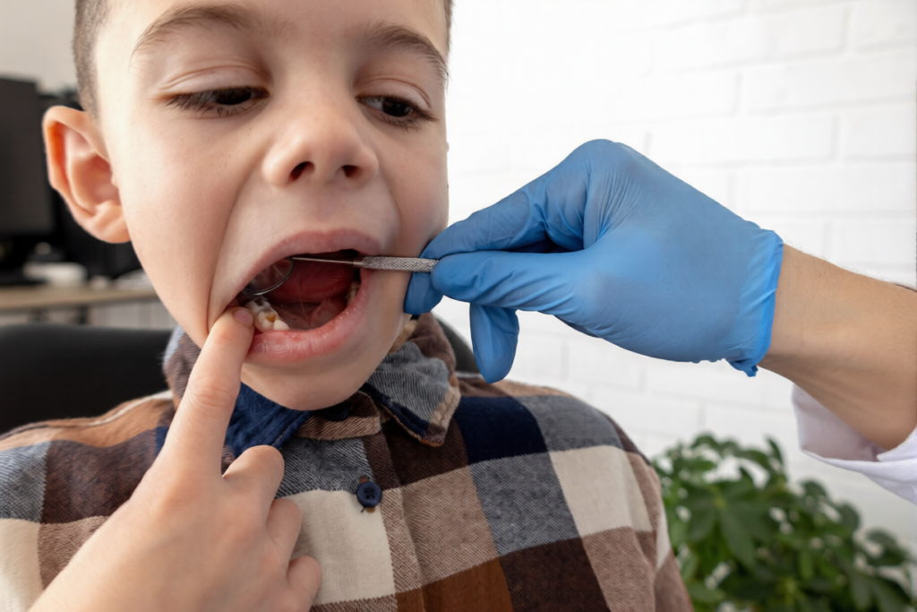 A little boy lost a baby tooth early due to tooth decay.